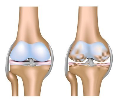 Arthrose du genou: à droite un genou sain et à gauche un genou avec de l'arthrose
