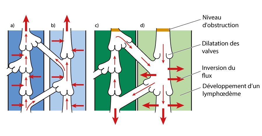 Illustration du lymphoedeme